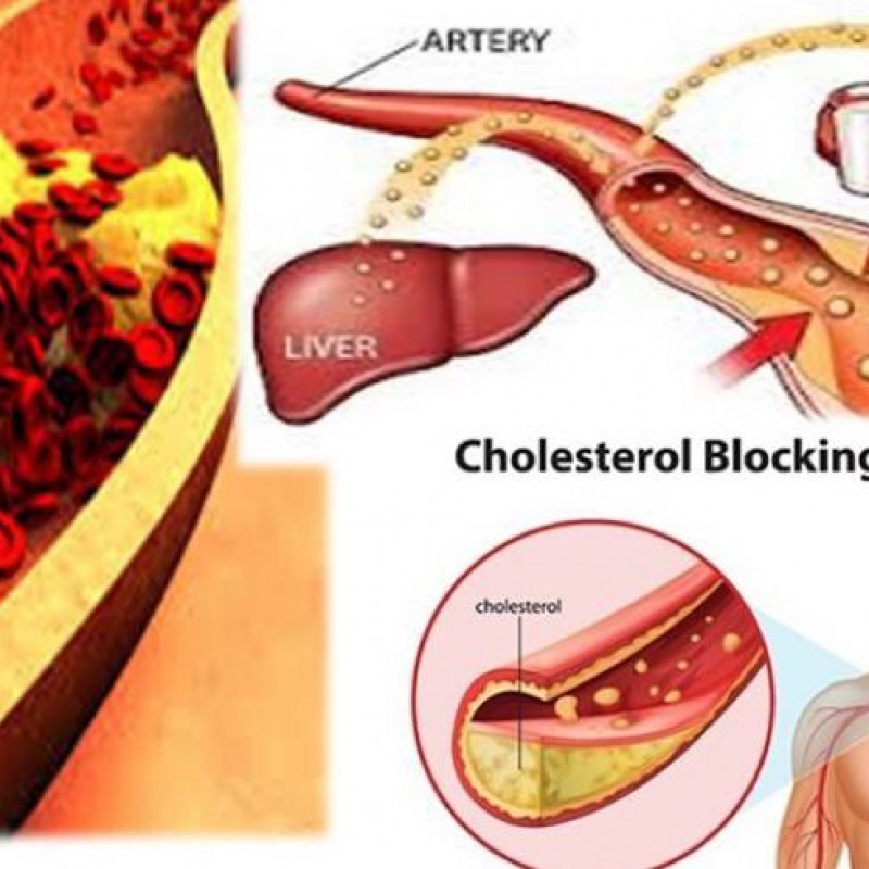 High Cholesterol