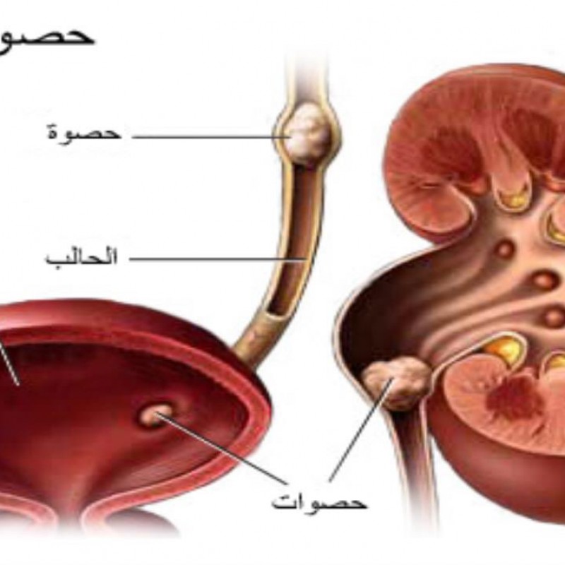 Kidney Stones