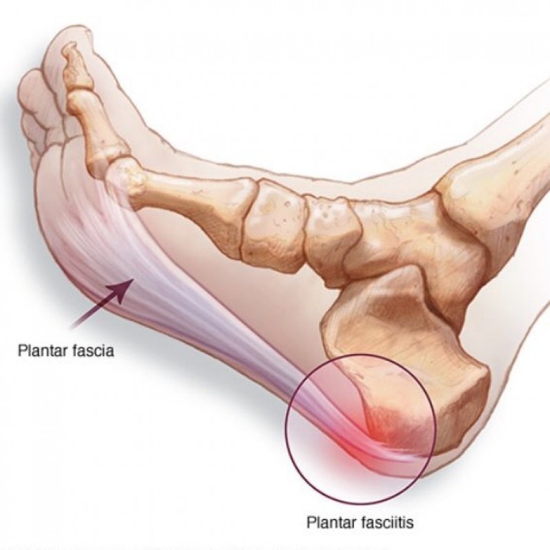 Heel and sole pain