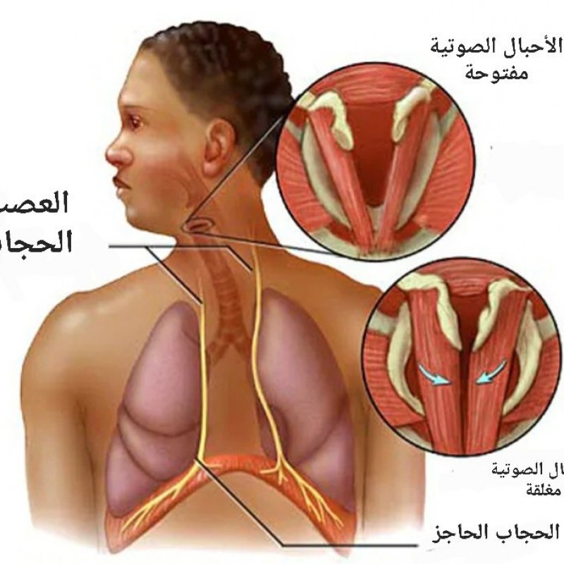 الفواق أو الحازوقة