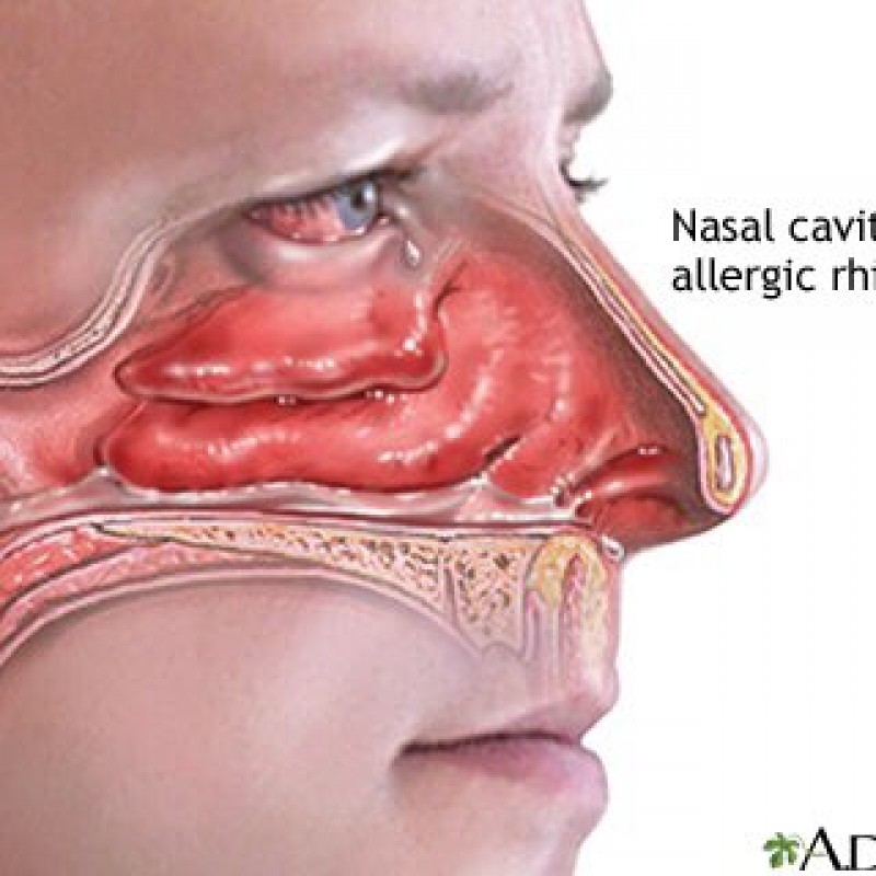 Allergic Rhinitis