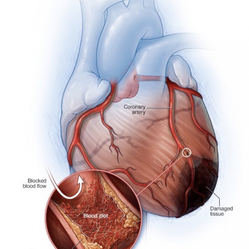 النوبة القلبية