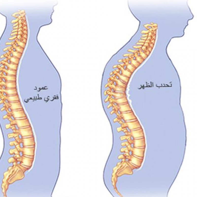 تحدب الظهر