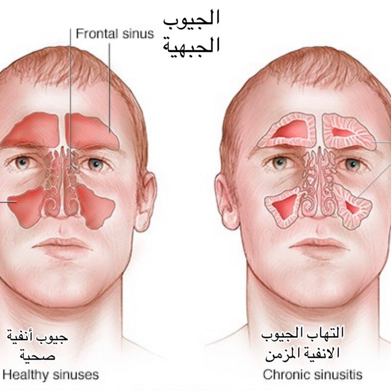 التهاب الجيوب الانفية