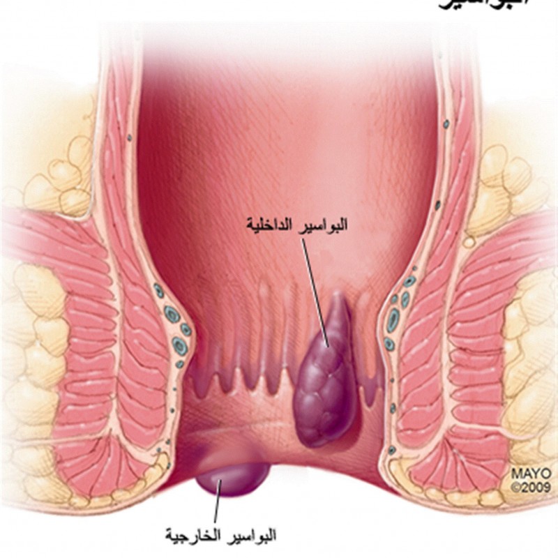 البواسير الأسباب والعلاج